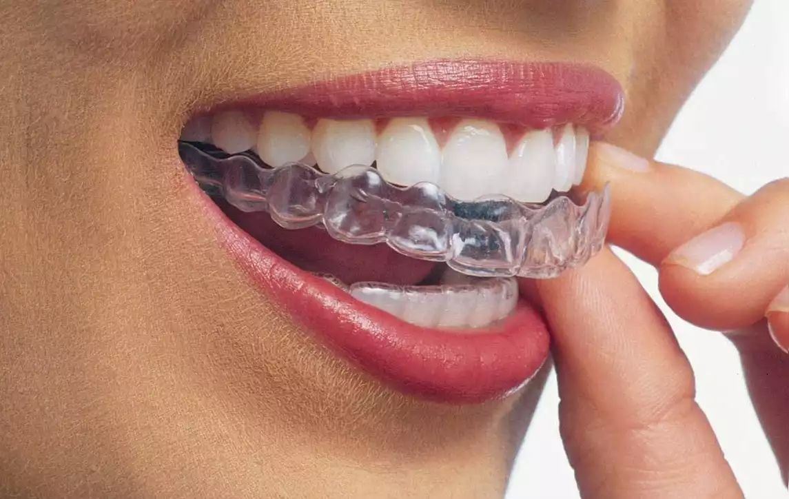 Invisalign